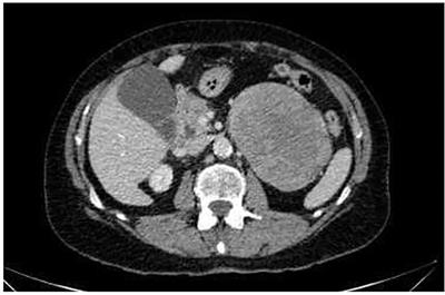 Neuroblastic Tumors of the Adrenal Gland in Elderly Patients: A Case Report and Review of the Literature